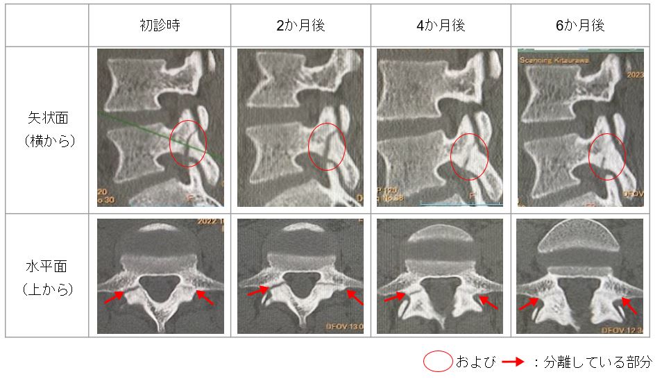 腰椎分離症のリハビリテーション｜北戸田ナノ整形外科泌尿器科